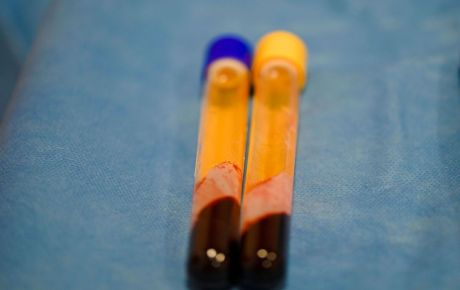 Πλασμαφαίρεση: Η νέα τάση στο anti-aging – Τι πραγματικά ισχύει;